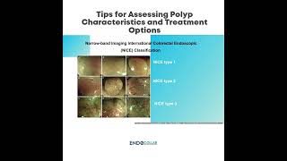 Tips for Assessing Polyp Characteristics and Treatment Options [upl. by Guyon237]