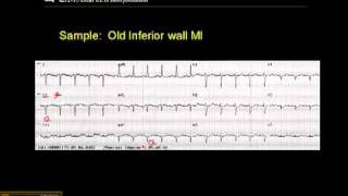 1215 Lead ECG Sample of an Old MI [upl. by Esma]