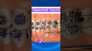 Impacted tooth during Braces [upl. by Reibaj]