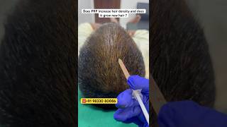 Top benefits of PRP for hair loss Boosts growth increases density shorts PRP HairCare hair [upl. by Assetnoc]