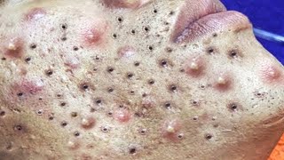 Big Cystic Acne Blackheads Extraction Blackheads amp Milia Whiteheads Removal Pimple Popping  5743 [upl. by Eidnyl]