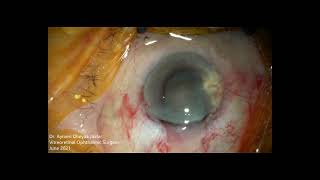 ECCE Extracapsular cataract Extraction [upl. by Nayb]