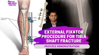 External Fixator Procedure For Tibia Shaft Fracture [upl. by Inig]