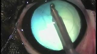 Cataracte avec implant [upl. by Assiram]