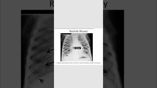 Rachitic rosaryricketsradiology neetpg [upl. by Bessy826]