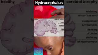 hydrocephalus  water in brain  awareness [upl. by Atiral]