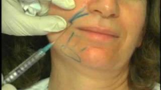 Sculptra Procedure Demonstration by Dr Mest  Part 1 [upl. by Neelhtak]