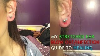 STRETCHED EAR BLOWOUT  HOW I HEALED MY EARS  Erika Anderson [upl. by Knut]