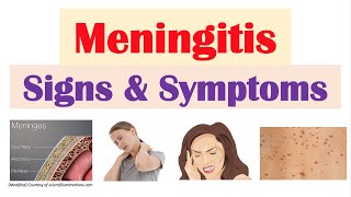 Meningitis Signs and Symptoms amp Why They Occur [upl. by Akenom556]