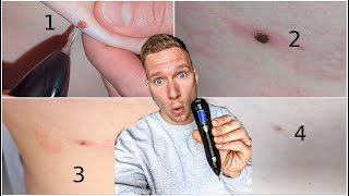 VOONEEN Mole Removal Pen  Leberflecke selbst entfernen 🤔 TEST [upl. by Asilenna192]