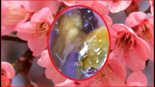 Ear wax removal water flush  Infected ear wax removal [upl. by Nahtal713]