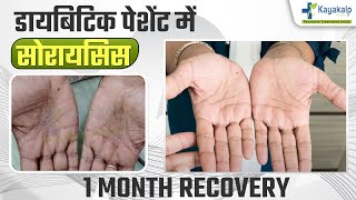 Diabetes में Psoriasis का इलाज कैसे होगा  Psoriasis Recovery in 1 Month Psoriasis Treatment India [upl. by Attah951]