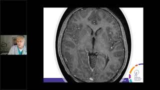 Medulloblastoma  Malignant Brain Tumor in Children amp Adults [upl. by Cioban]