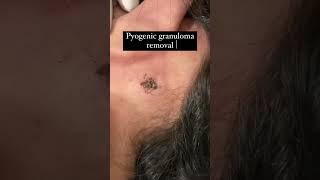 Pyogenic granuloma removalPyogenic granulomaco2laserlaser treatmentlaserdermatologist Surat [upl. by Moneta]