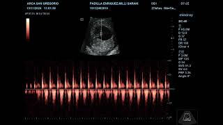 frecuencia embrionaria padilla enriquez [upl. by Siramad109]