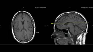 Unremarkable NonContrast Brain MRI Axial T1 Example 1 [upl. by Dario]