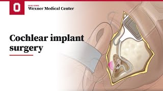 Cochlear implant surgery  Ohio State Medical Center [upl. by Dlaniger]