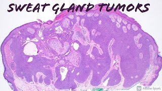 Sweat Gland Tumors  Solid Pink Pattern poroma hidradenomaacrospiroma amp family [upl. by Ahsaet]