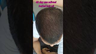 40 day use adivasi herbal hair oil and result and review adivasihairoil hairoil shorts viral [upl. by Mcferren746]