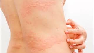 URTICARIA RONCHAS EN EL CUERPO CAUSAS SÍNTOMAS Y TRATAMIENTO [upl. by Engelbert]