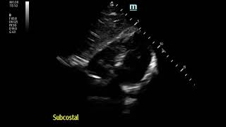 Severe Pleuritic MidChest Pain in 17 yo Boy Pneumomediastinum [upl. by Artemis]