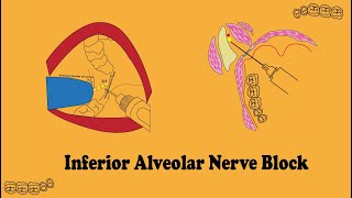 inferior alveolar nerve block in detail [upl. by Ahseikan634]