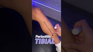 ¿Qué es la periostitis tibial fisioterapia lesiones runner [upl. by Carlota809]