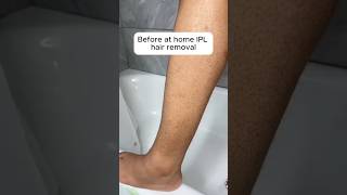 AtHome IPL Hair Removal Before amp After Results！ nomorewaxing laserhairremovalrxmoore [upl. by Omlesna660]