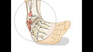 Lateral Ankle Sprain vs High Ankle Sprain Whats the Difference [upl. by Onailerua]