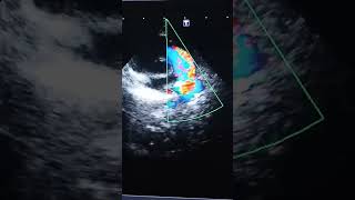 Patent Ductus Arteriosus ECHOCARDIOGRAM cardiacanatomy [upl. by Eyeleen]