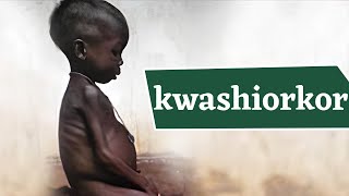 Kwashiorkor Disease What Causes Kwashiorkor जानिये क्वाशियोरकर रोग क्या है इसके लक्षण व उपाय [upl. by Aiza737]