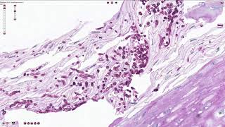 Mycotic Esophagitis  Histopathology [upl. by Nnairret]