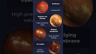 Acute Otitis Media Otoscopy [upl. by Yellhsa]