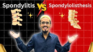 spondylitis vs spondylolisthesis  spondylitis  Spondylolisthesis  everything you need to know [upl. by Birkner]