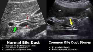 Bile Duct Ultrasound Normal Vs Abnormal Image Appearances  Biliary Tract Abnormalities USG Scan [upl. by Furnary]