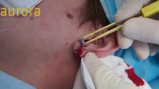 Stretched Earlobe Tribal Earlobe Flesh Tunnel Repair  Aurora Clinics [upl. by Seldun129]