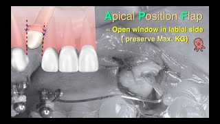 Apical position flap design for exposing upper impacted canine in aligner treatment｜【CC Ortho】CC705 [upl. by Alyosha]