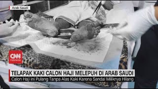 Telapak Kaki Calon Haji Melepuh di Arab Saudi [upl. by Tugman]