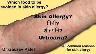 Skin allergy in hindi urticariaपित्ती शीतपत्ति causesfood and other allergen Dr Gaurav patel [upl. by Rob]