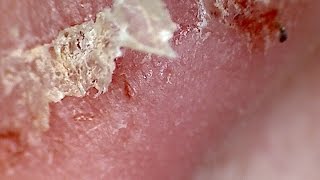 Magnified Scab Picking [upl. by Bowlds]