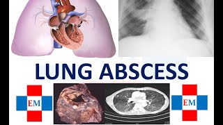 Lung Abscess Classification Causes Clinical features Diagnosis Treatment Respiratory Lecture 3 [upl. by Alleunamme]