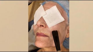 TCA Peel Application and Entire Peeling Process [upl. by Malvia]