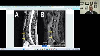 Navneet bodduRole of mesenchymal stemcells for systemic illnesses [upl. by Aseeram906]