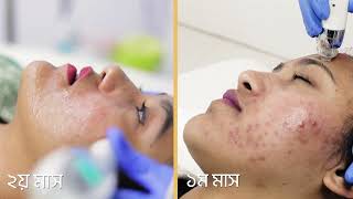 Advanced EPN Treatment ব্রণ মেছতা ডার্ক স্পট রিংকেল ও চুল সহ সব সমস্যার সমাধান [upl. by Coffey]