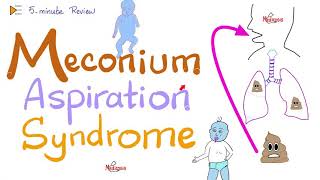 Meconium Aspiration Syndrome MAS  5Minute Review [upl. by Letniuq889]