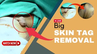 Tag Removal removal by Laser  Skin Tag Treatment in Delhi  Skin Tag Surgery  SkinQure [upl. by Issy]