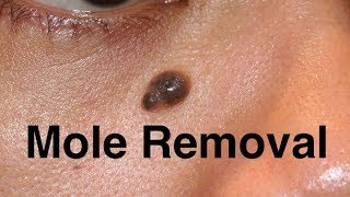 Removal of Precancerous Mole Naturally Liquid Nitrogen Cryotherapy Electrosurgery or  Home Houston [upl. by Acinnor]