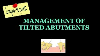 MANAGEMENT OF TILTED ABUTMENTS  FPD [upl. by Lucila]