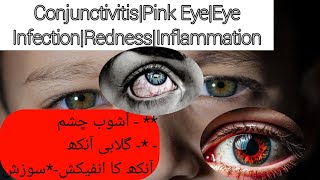 ConjunctivitisPink EyeEye InfectionRednessInflammationDr hafiz Abdul sattar anjumUrduHindi [upl. by Mordy]