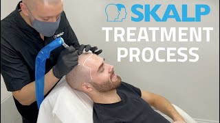 Skalp® Scalp Micropigmentation Treatment Process [upl. by Eiramanad12]